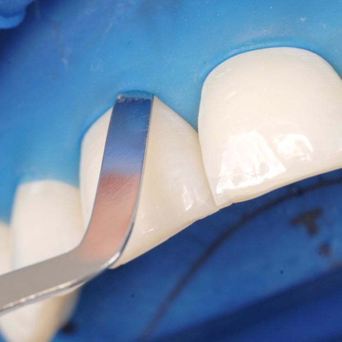 Nahaufnahme der Isolation mit OptraDam im Frontzahnbereich