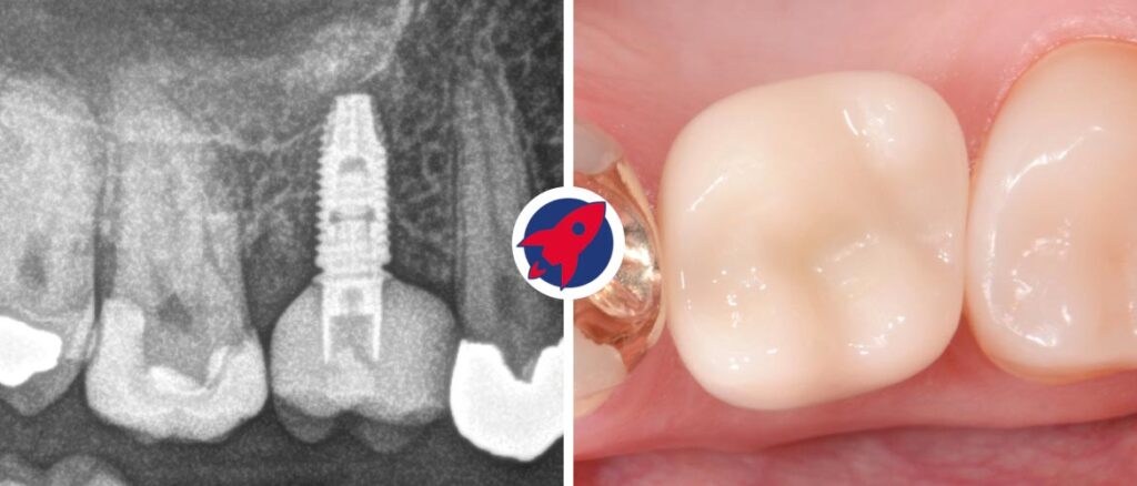 Zahnimplantat links im Röntgenbild und rechts das klinische Ergebnis nach Implantatversorgung
