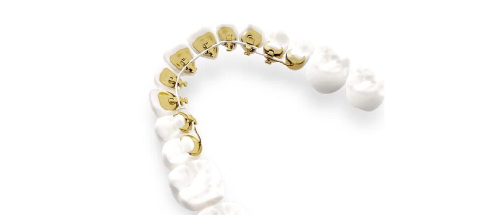 Lingualtechnik zur unsichtbaren Zahnkorrektur mit innenliegenden Brackets