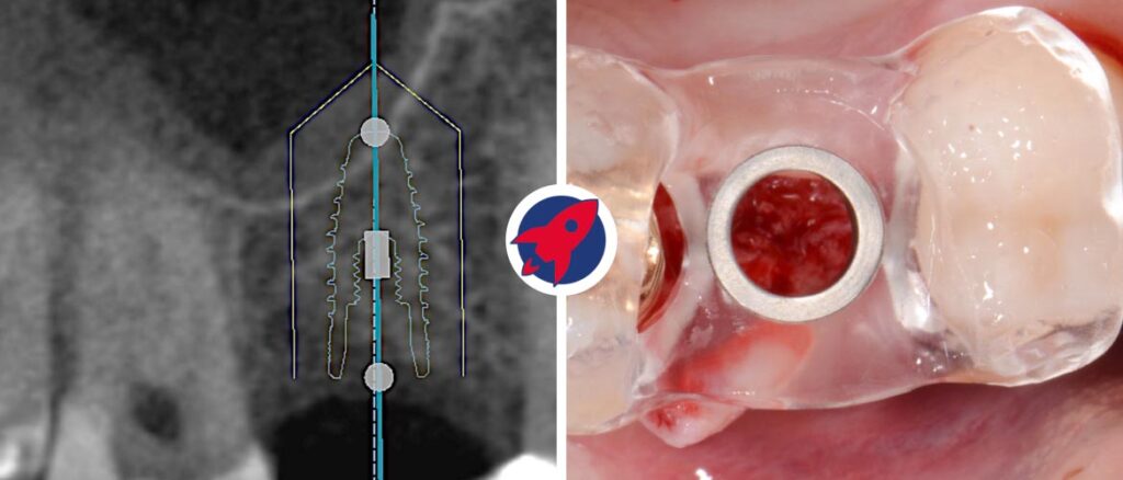 Digitale Volumentomographie und individuell geplante Bohrschablone für präzise Implantation