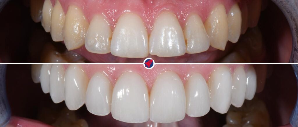 Veneers vorher und nachher – natürlich wirkende Ästhetik und harmonisches Lächeln