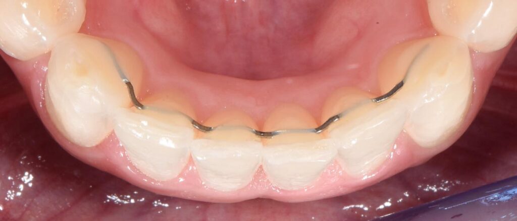 Präziser fester Retainer an der Unterkiefer-Front, hergestellt durch unseren innovativen Biegeroboter für maximale Passgenauigkeit