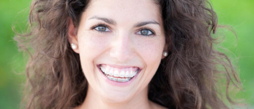 Patientin mit ästhetischen Keramikbrackets während kieferorthopädischer Behandlung