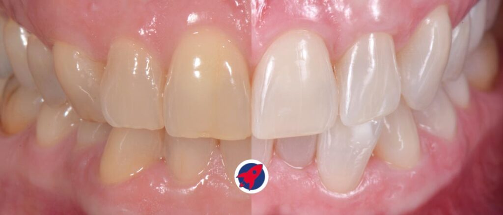 Zahnbleaching vorher und nachher – sichtbar hellere Zähne mit natürlichem Ergebnis