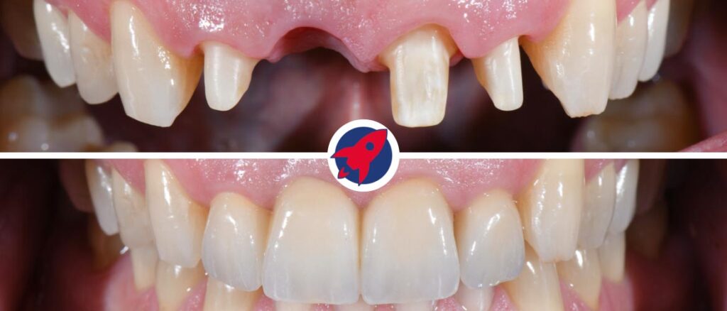 Vorher-nachher-Vergleich einer hochwertigen Zahnbrücke mit natürlicher Ästhetik