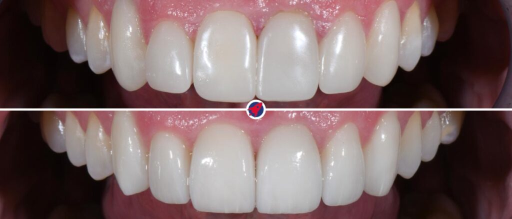 Vorher-Nachher Vergleich Veneers Austausch: Oben alte, unnatürliche Verblendschalen. Unten neue, natürlich wirkende Keramik-Veneers nach Invisalign-Behandlung und ästhetischer Neugestaltung