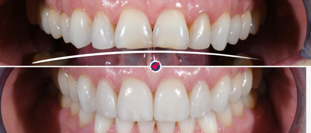 Vorher-Nachher-Vergleich einer Zahnrekonstruktion: Oben deutlich abgenutzte Zähne vor der Behandlung – unten das ästhetische Ergebnis nach einer erfolgreichen Korrektur mit Invisalign und Veneers.
