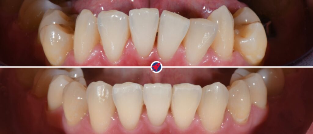 Kieferorthopädische Korrektur der Unterkiefer-Frontzähne - Vorher-Nachher-Vergleich nach Aligner-Therapie