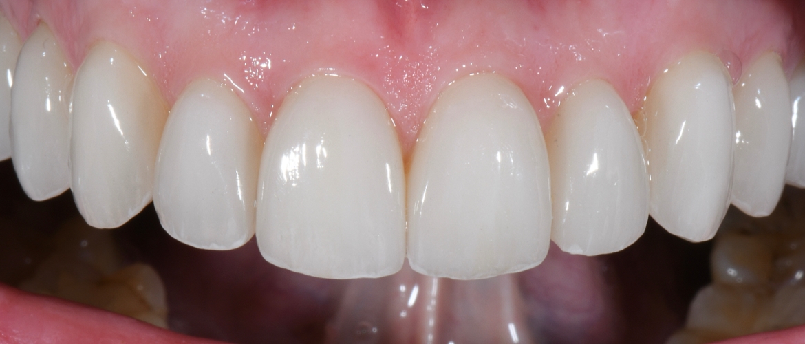Zehn Veneers im Oberkiefer in natürlicher Zahnform und Farbverlauf in Nahaufnahme