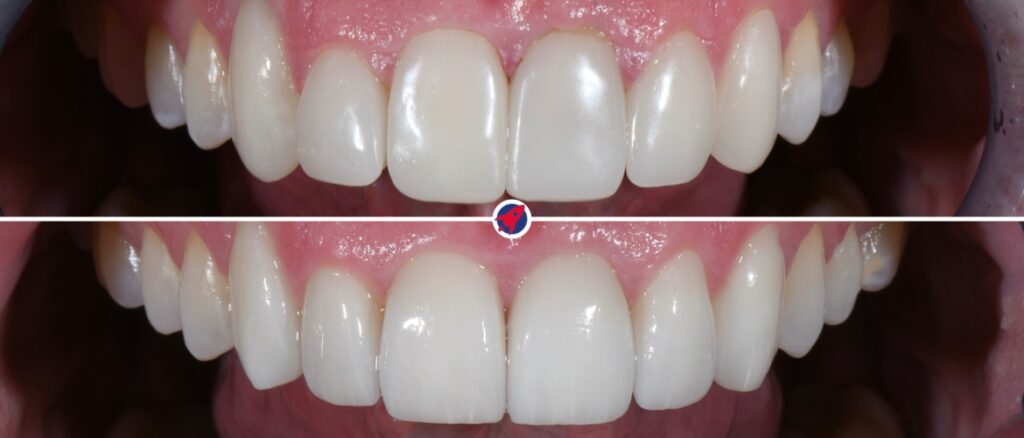 Veneers im Vergleich: vorher plump und schlecht sitzend, nachher individuell und natürlich schön